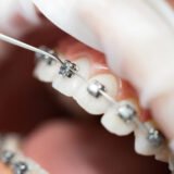 Braces treatment at Al Lulu Medical Center