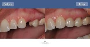 Dental IMplant-Sharjah-Lulu