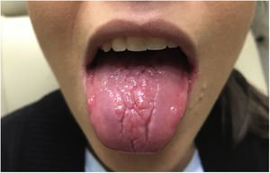 glossitis glossitis